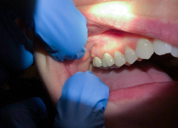 Best Emergency Wisdom Teeth Removal in Mineral Wells, TX
