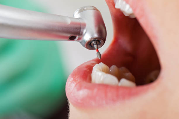 Best Emergency Dental Care for Broken or Chipped Teeth in Mineral Wells, TX